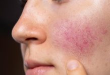Rosacea dhe tiroidja: A kanë lidhje me njëra-tjetrën?