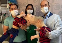 Pas 14-ore operacion fëmijët binjak ndahen pas një viti të bashuar kokë më kokë. Shikoni si duken tani